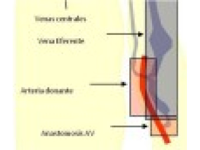 DOPPLER DE FÍSTULA ARTERIO-VENOSA DE DIÁLISIS DISFUNCIONANTE